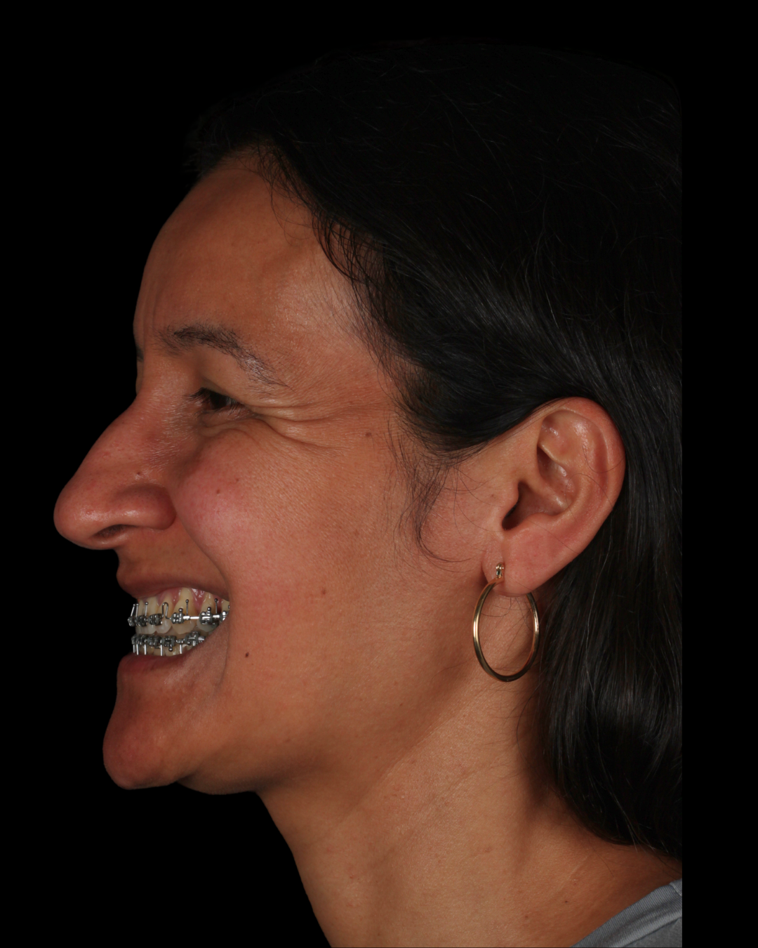 cirurgiaortognaticaportoalegrecirurgiabucomaxilofacial233 (2)